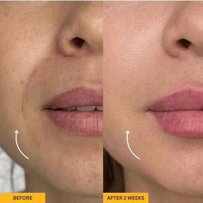 Lymphatic  Brush for Snatched Face